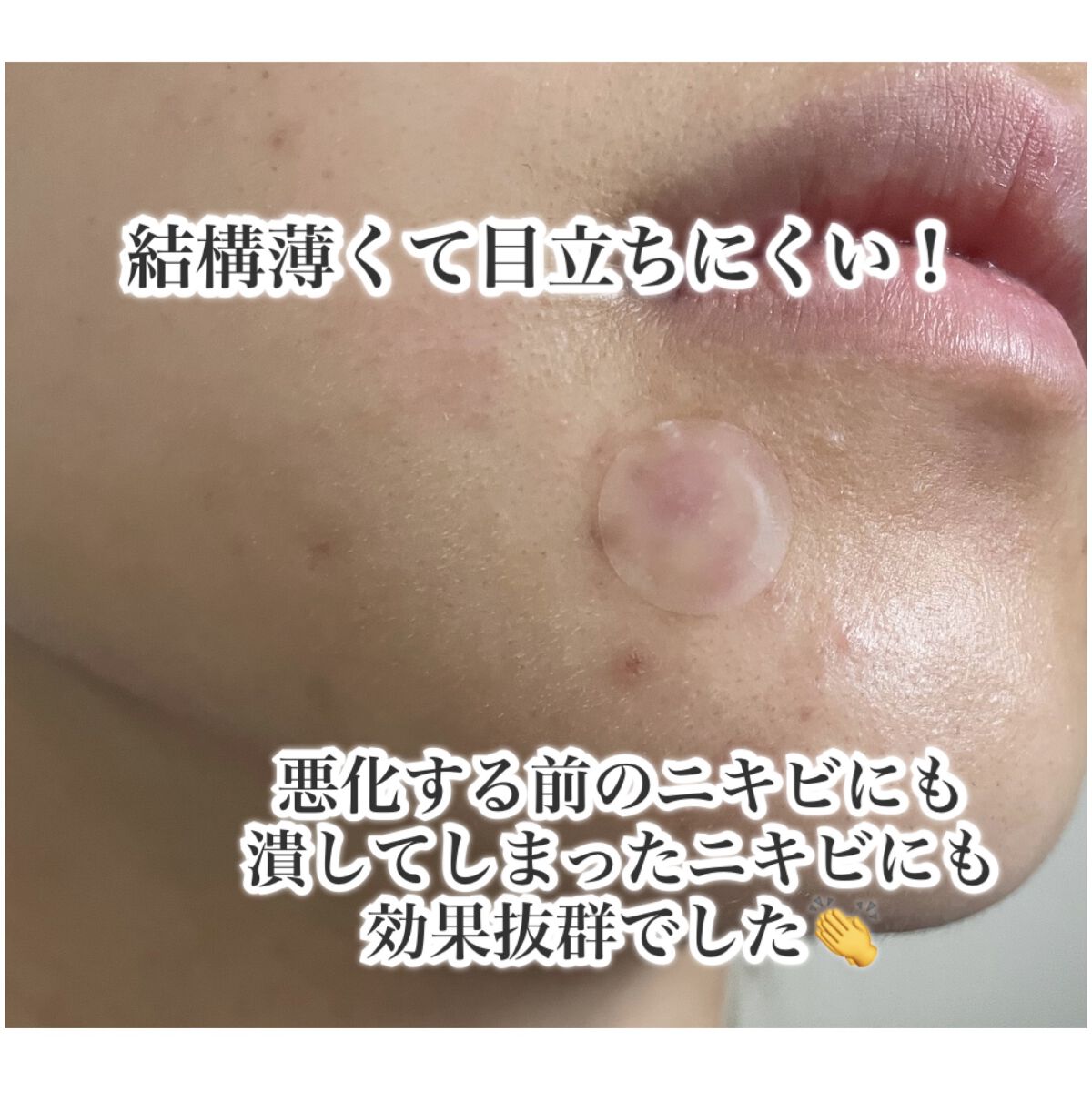 プロCICA クリアスポットパッチ/VT/その他スキンケアを使ったクチコミ（2枚目）