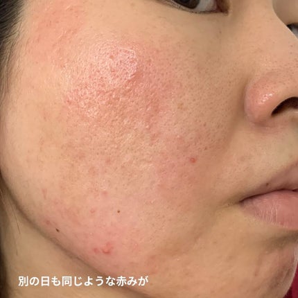 マジックティーツリーオイル/ブラン/フェイスオイルを使ったクチコミ(4枚目)