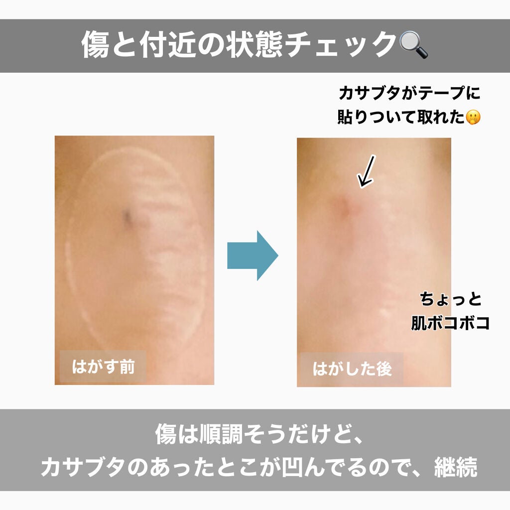 キズパワーパッド/バンドエイド/その他を使ったクチコミ(3枚目)