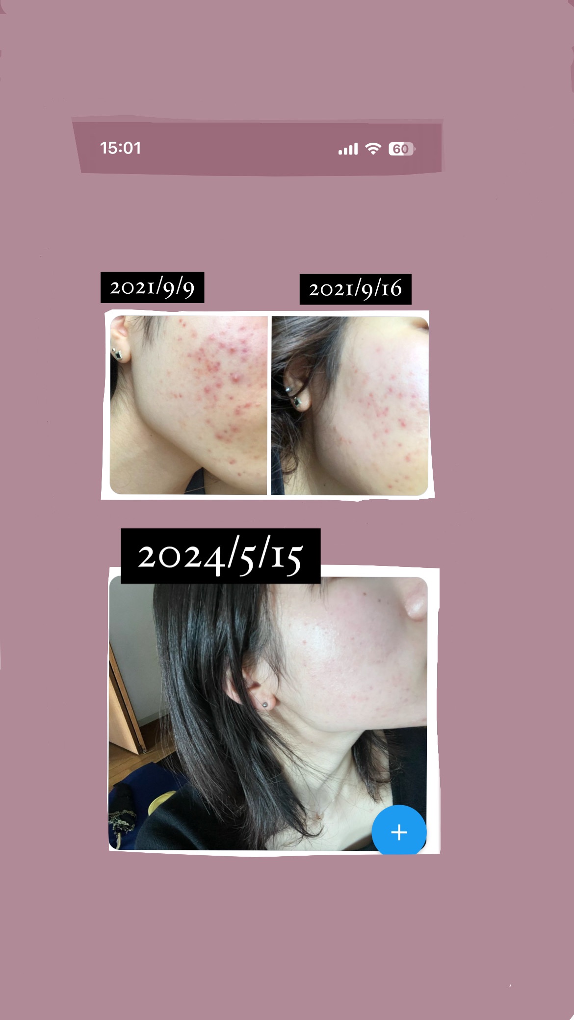 AZアゼライン酸10セラム/コスデバハ/美容液を使ったクチコミ（1枚目）