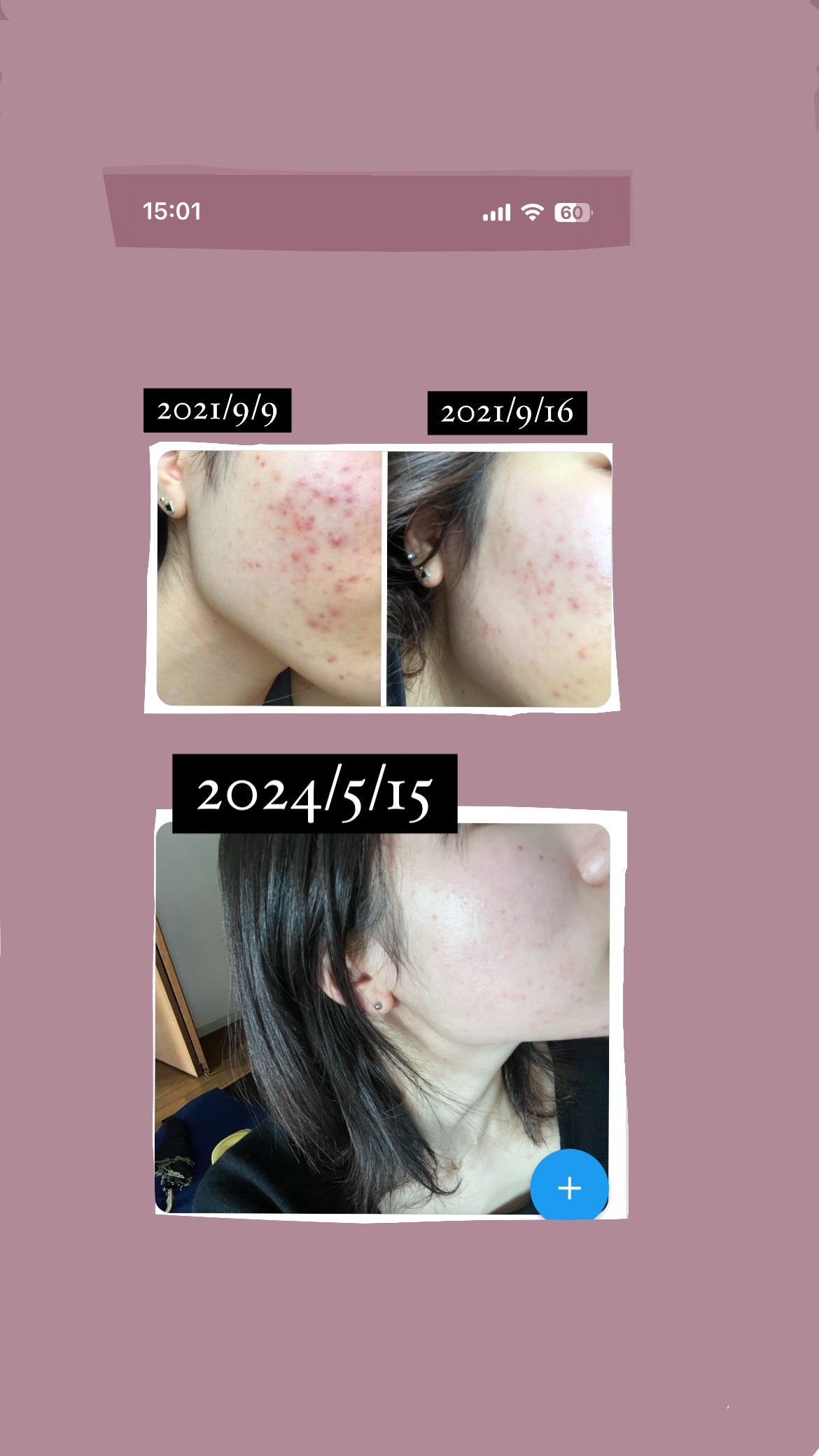 AZアゼライン酸10セラム/コスデバハ/美容液を使ったクチコミ(1枚目)