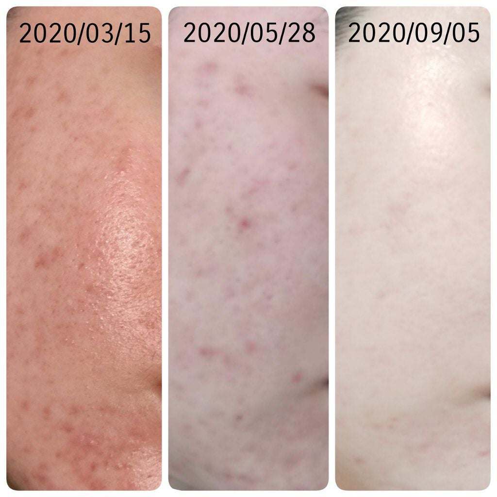 プロステージ VC100 ビタミンC モイスチャーローションリッチ/ナチュリア/化粧水を使ったクチコミ(3枚目)