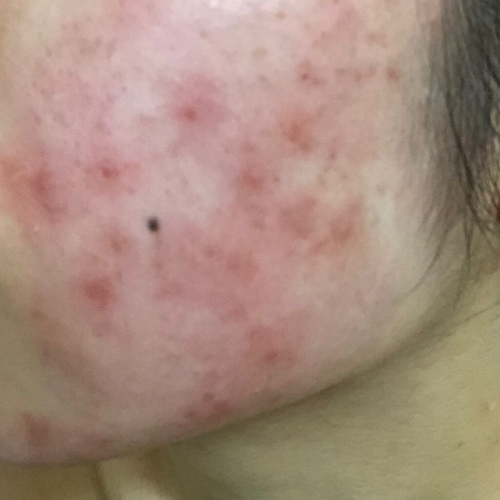 エピデュオゲル/マルホ株式会社/その他を使ったクチコミ（3枚目）