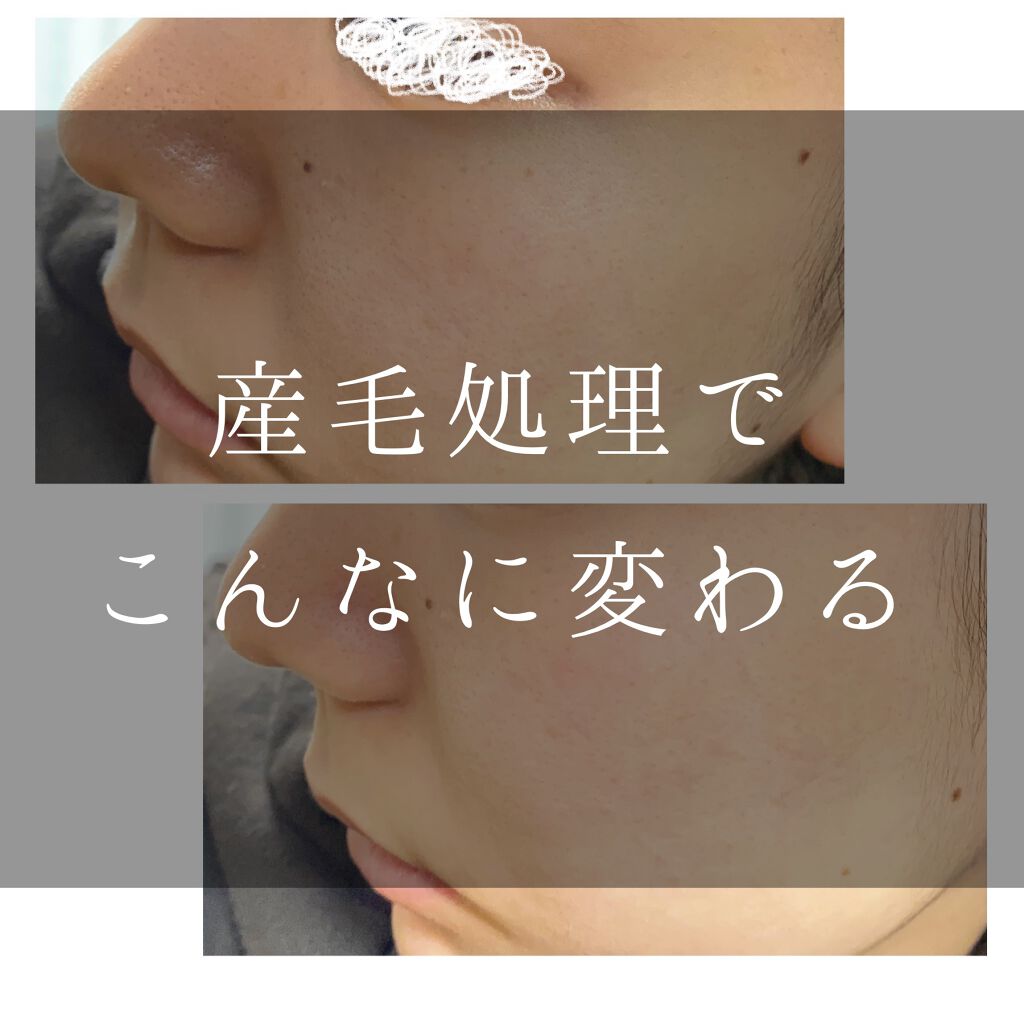 フローレス/フローレス/シェーバーを使ったクチコミ（1枚目）