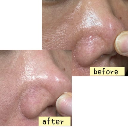 レッドアクネピーリングセラム/MEDICUBE/美容液を使ったクチコミ(3枚目)