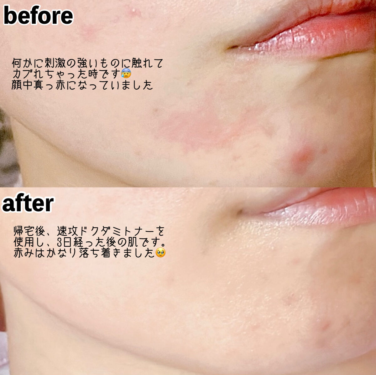 ドクダミ 77 スージングトナー/Anua/化粧水を使ったクチコミ（3枚目）