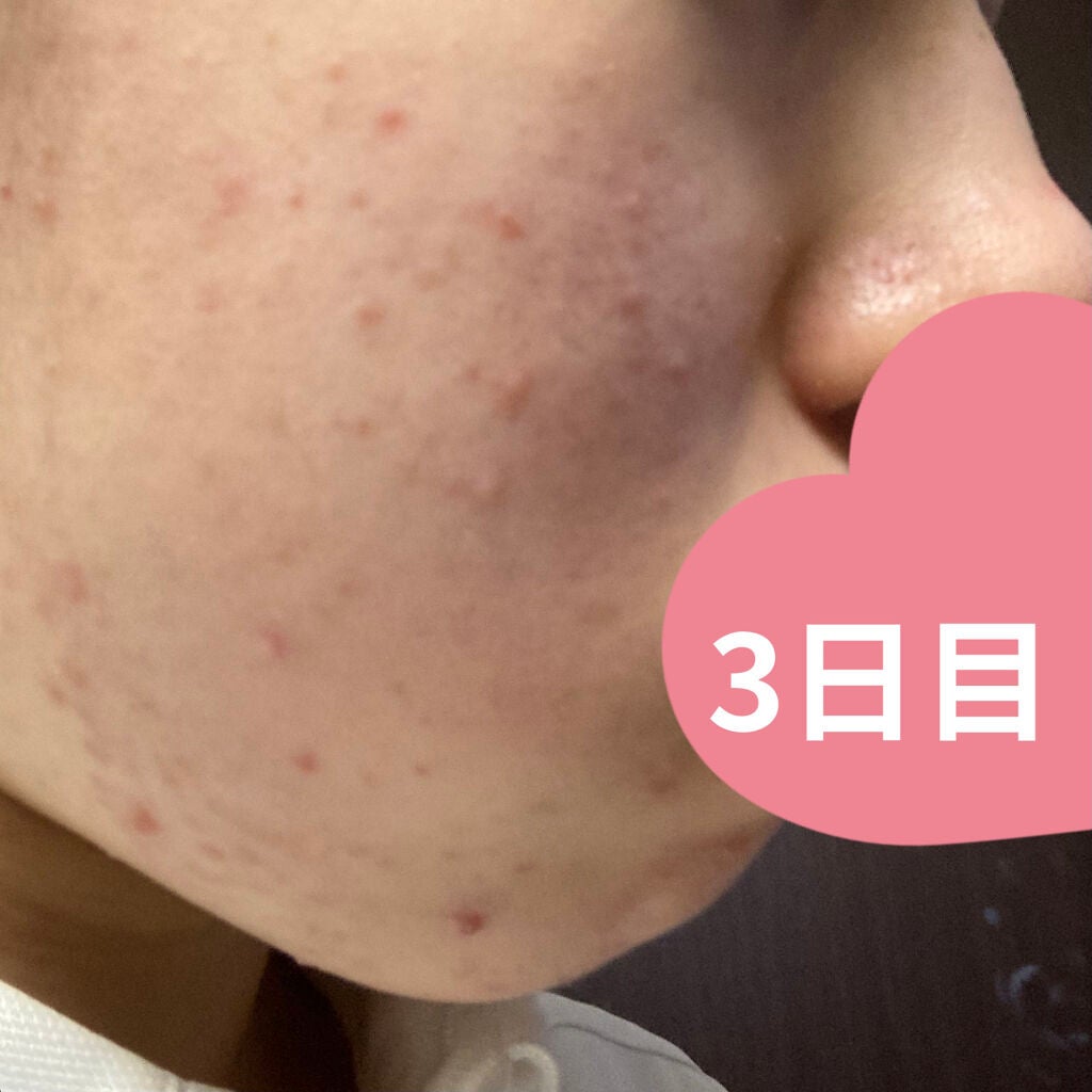 クリアトライアルセット M(しっとりタイプ)/オルビス/トライアルキットを使ったクチコミ(5枚目)