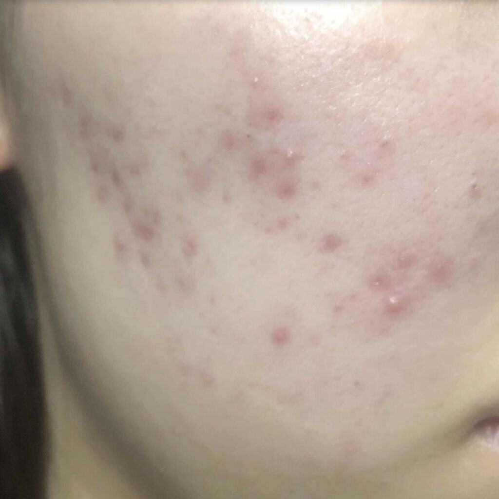 ペアアクネクリームW(医薬品)/ペア/その他を使ったクチコミ（2枚目）