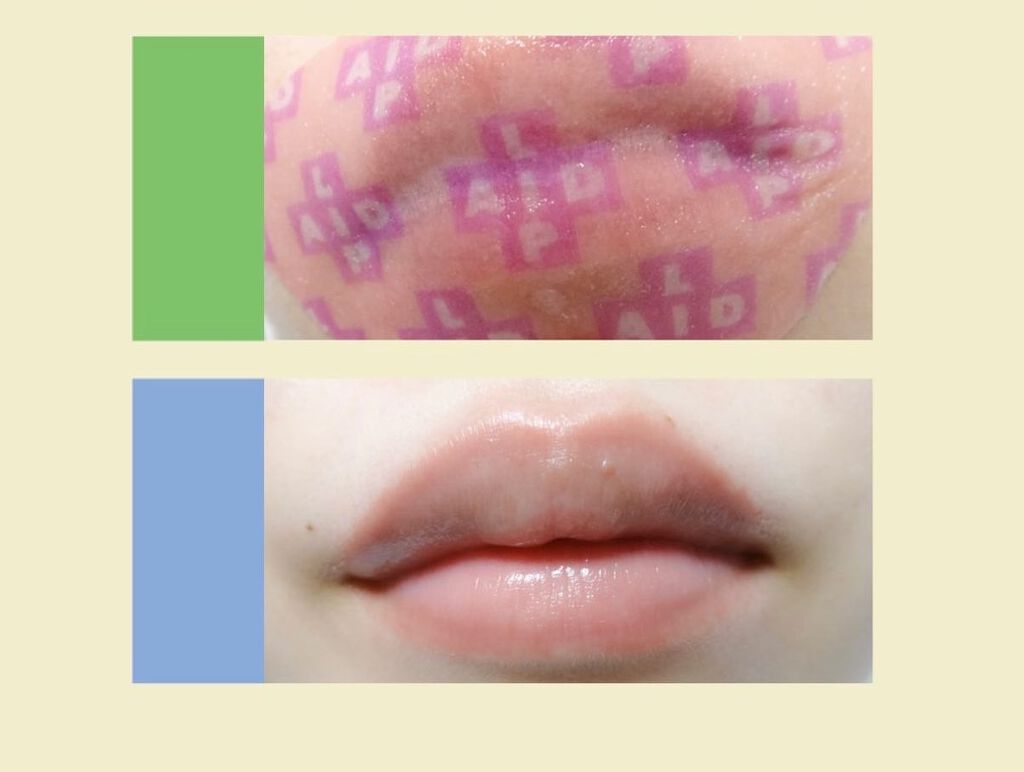 リップエイド集中マスク/トレンドホリック/リップマスクを使ったクチコミ(9枚目)