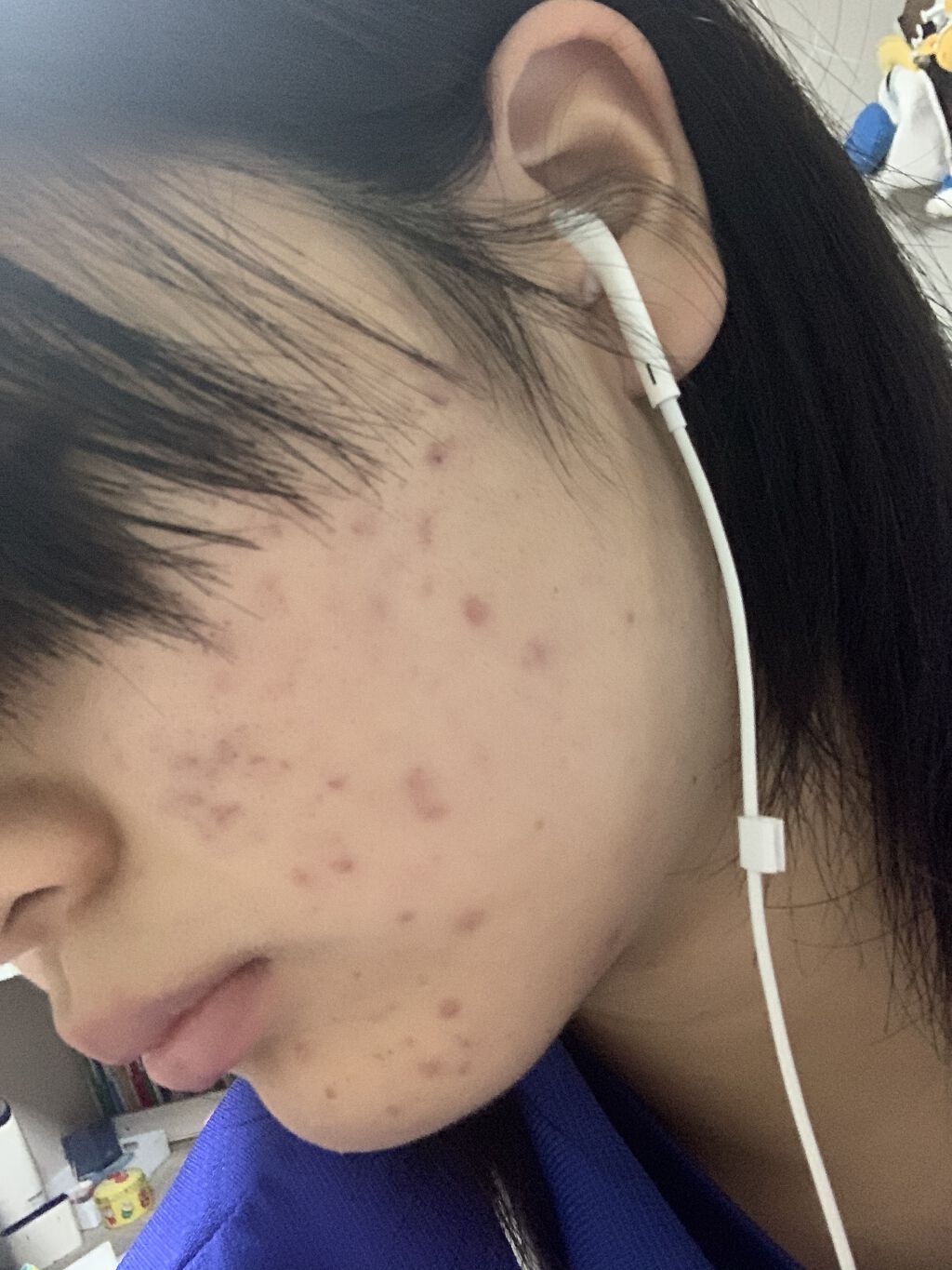 ロゼット洗顔パスタ アクネクリア/ロゼット/洗顔フォームを使ったクチコミ（2枚目）