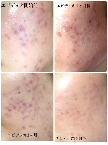 アクネケアローション W/d プログラム/化粧水を使ったクチコミ(2枚目)