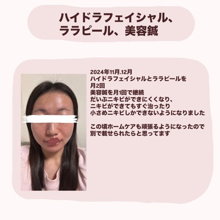 お芋ちゃん|10年以上ニキビに悩む保育士 on LIPS 「2024年7月から、エステサロンで受けた美容施術です。★ハイド..」(5枚目)