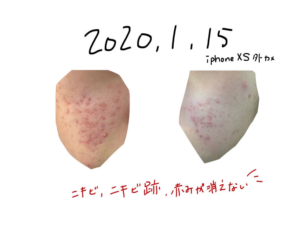 にこちゃん on LIPS 「塗り薬を使って約一年の結果こんにちは!約一年前に、LIPSを初..」(2枚目)