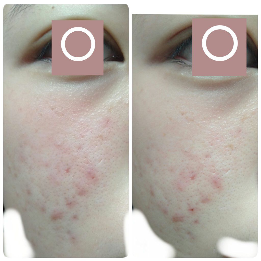 薬用しみ対策 美白化粧水/メラノCC/化粧水を使ったクチコミ(2枚目)