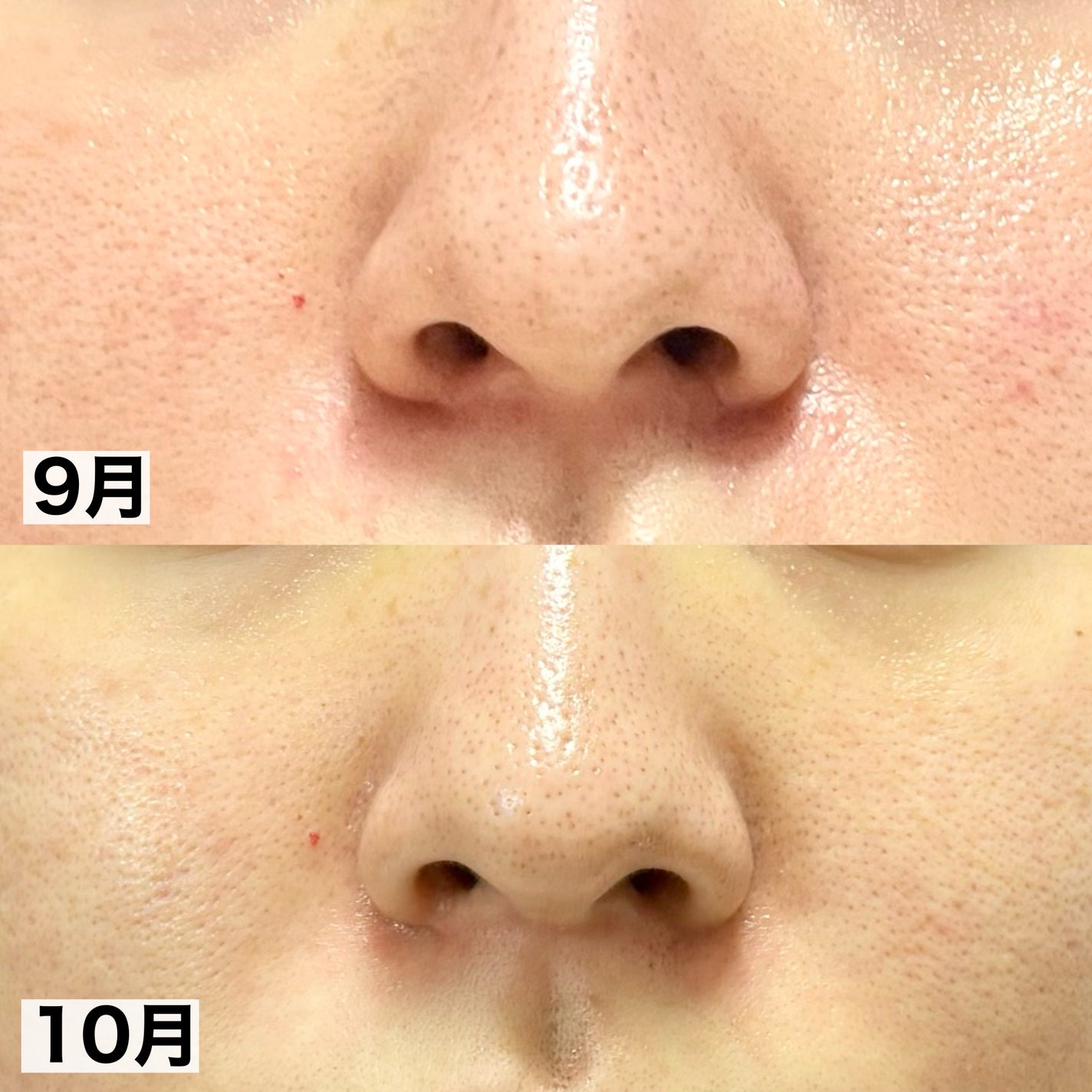 ã¶ã»ã¿ã€ã R ã¢ã¯ã¢/IPSA/åç²§æ°Žã䜿ã£ãã¯ãã³ãïŒ4æç®ïŒ