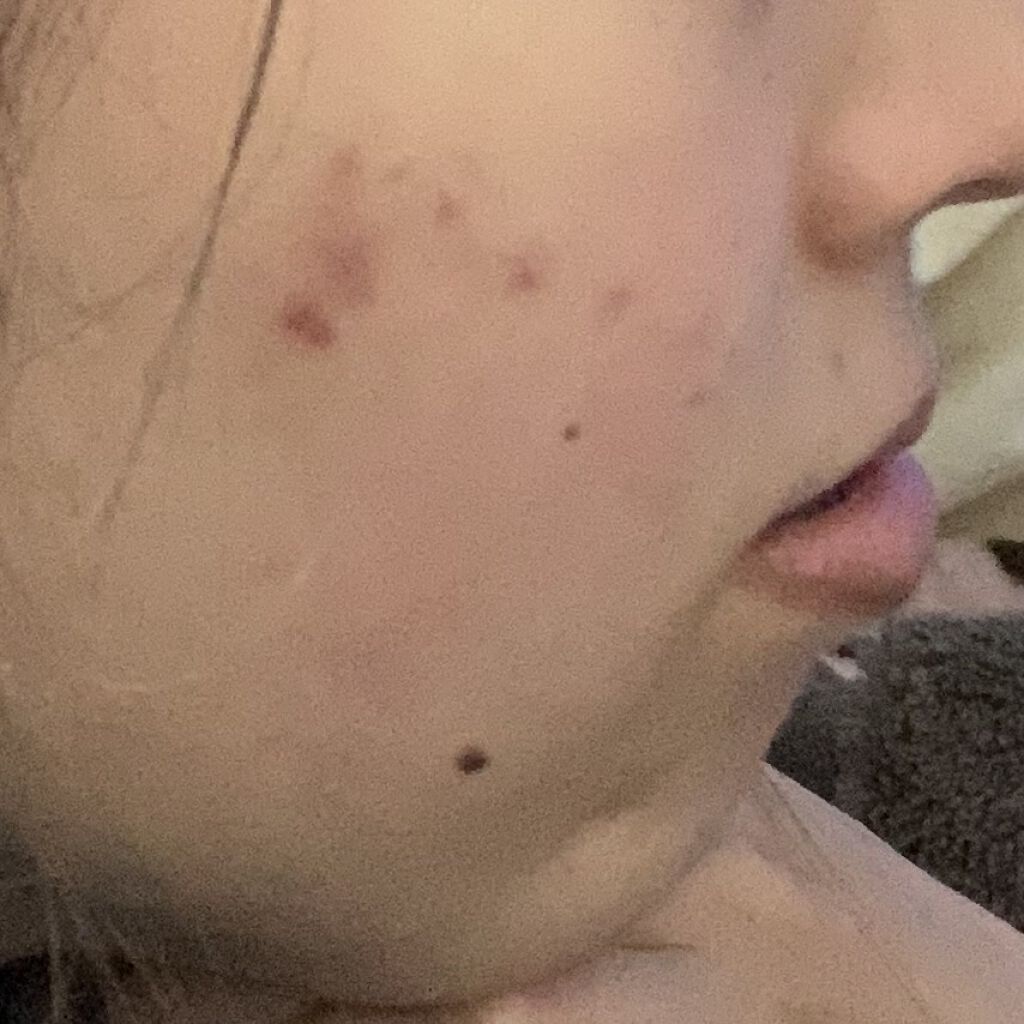 薬用 しみ 集中対策 美容液/メラノCC/美容液を使ったクチコミ（2枚目）