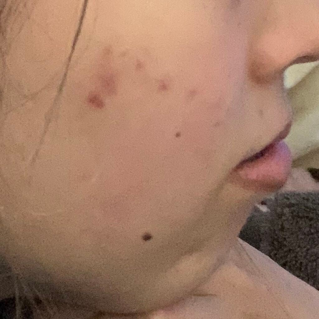 薬用 しみ 集中対策 美容液/メラノCC/美容液を使ったクチコミ(2枚目)