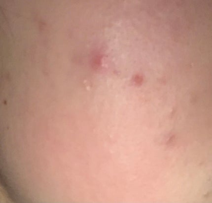 オードムーゲ 薬用ローション(ふきとり化粧水)/オードムーゲ/拭き取り化粧水を使ったクチコミ(1枚目)