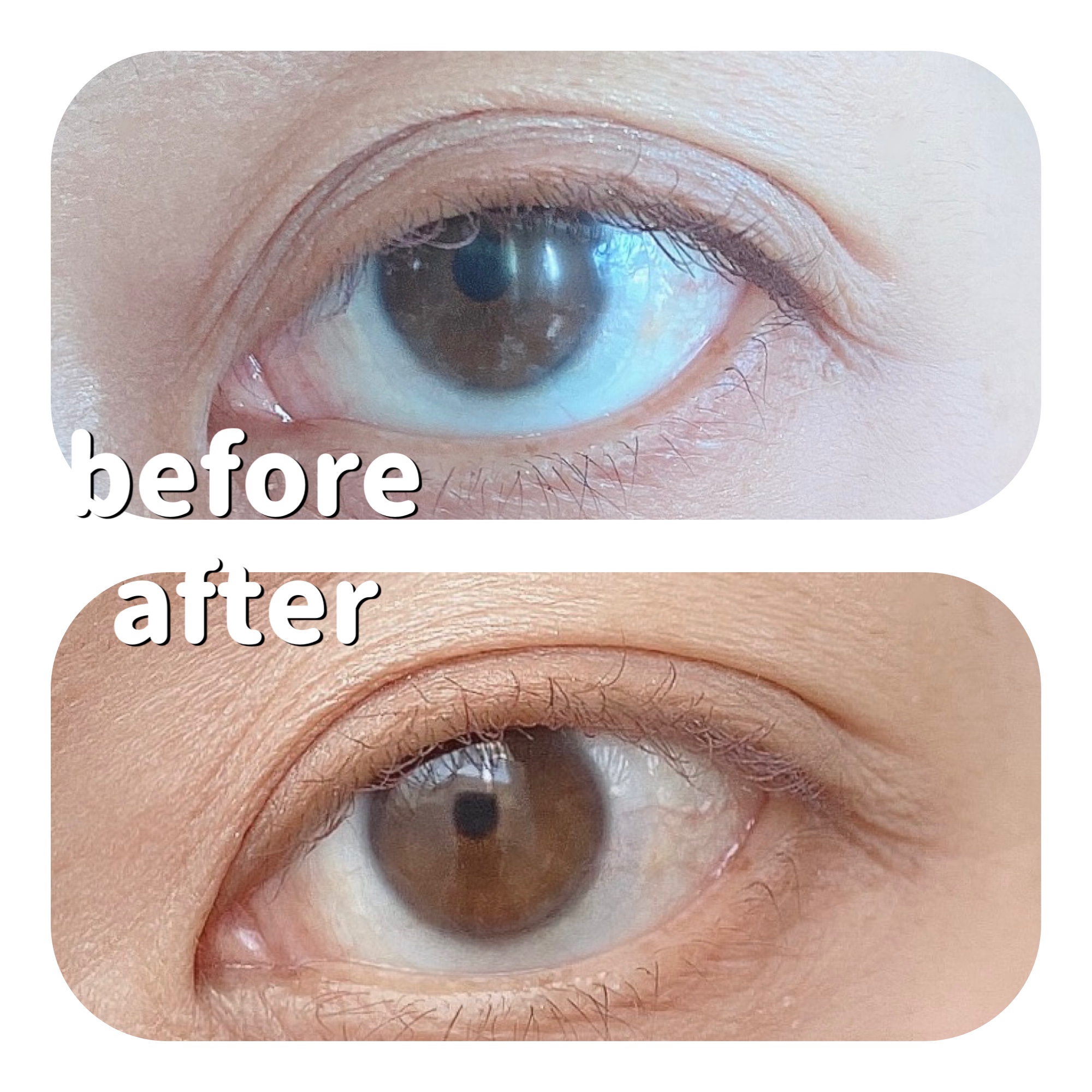 メザイク イージークリア 接着クリアタイプ/メザイク/二重まぶた用アイテムを使ったクチコミ（1枚目）