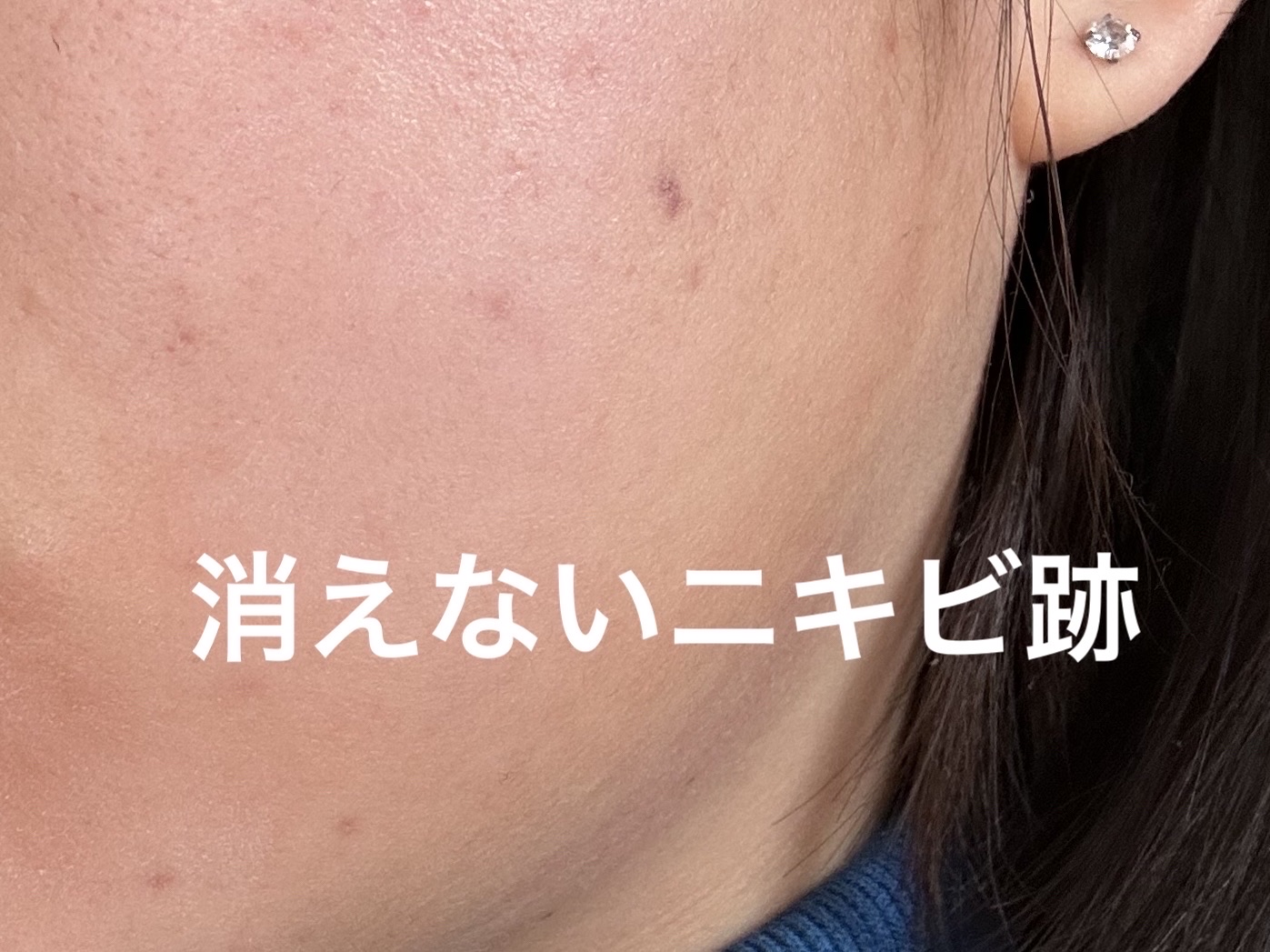 薬用コンシーラー アクネプロテクター/ONLY MINERALS/パウダーコンシーラーを使ったクチコミ（3枚目）