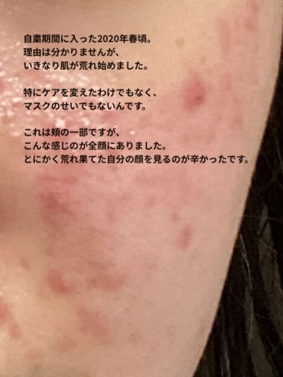 モイストケア エマルジョン MB/d プログラム/乳液を使ったクチコミ（2枚目）