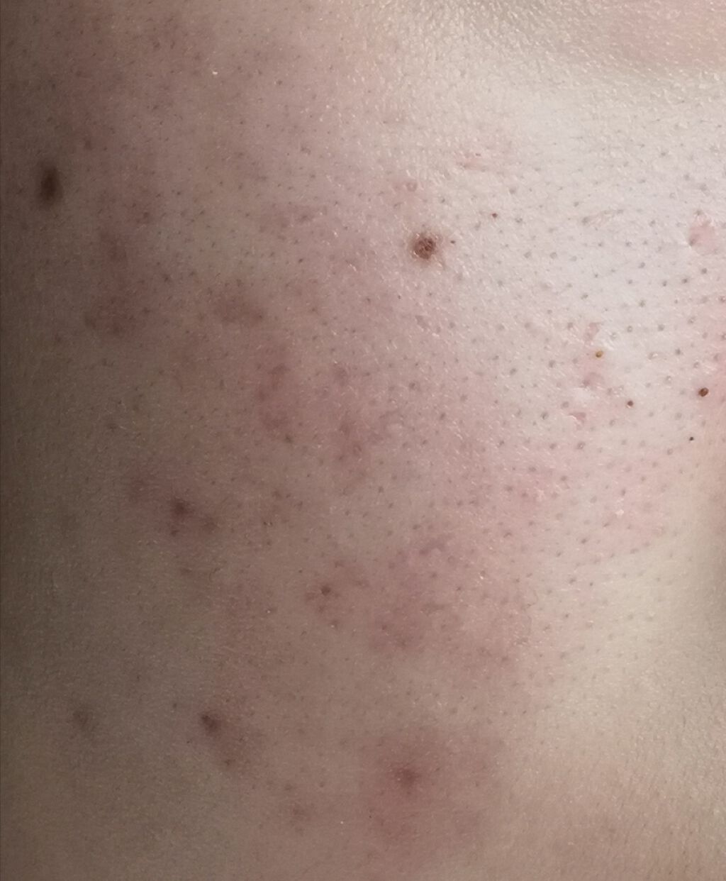 薬用 しみ 集中対策 美容液/メラノCC/美容液を使ったクチコミ(2枚目)