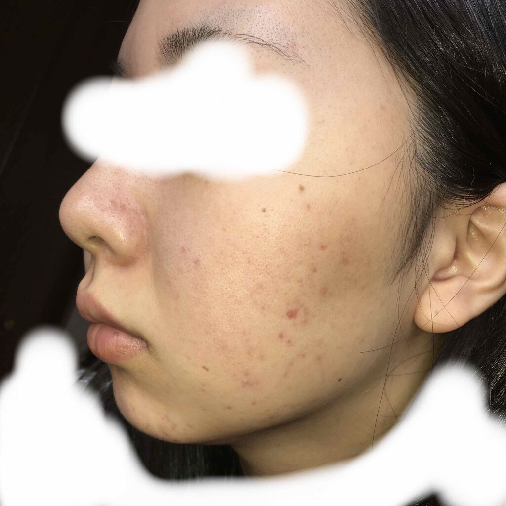 デュアック配合ゲル/ポーラファルマ/その他を使ったクチコミ（2枚目）