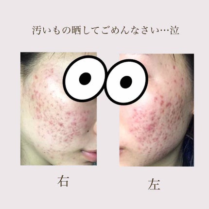 ピュアビューエッセンスPL プラセンタ/ジャパンギャルズ/美容液を使ったクチコミ(2枚目)