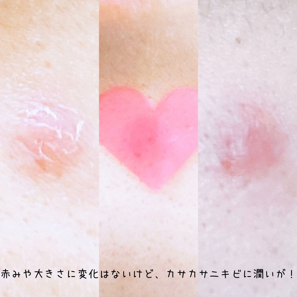 LOVE ME SKIN PATCH /コジット/シートマスク・パックを使ったクチコミ(5枚目)