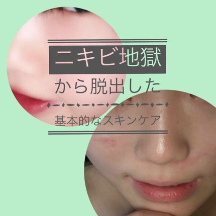 テラ・コートリル 軟膏(医薬品)/ジョンソン・エンド・ジョンソン/その他を使ったクチコミ(1枚目)