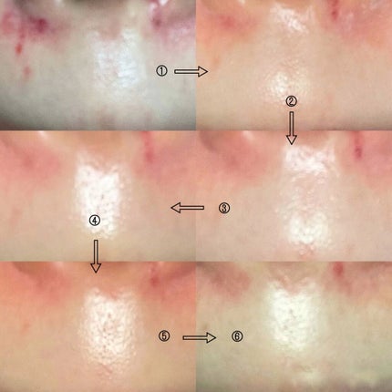 ブルベかもしれないイエベちゃん on LIPS 「鼻の周りに血管が浮き出てる人👃私はステロイドの使用のしすぎか、..」(2枚目)