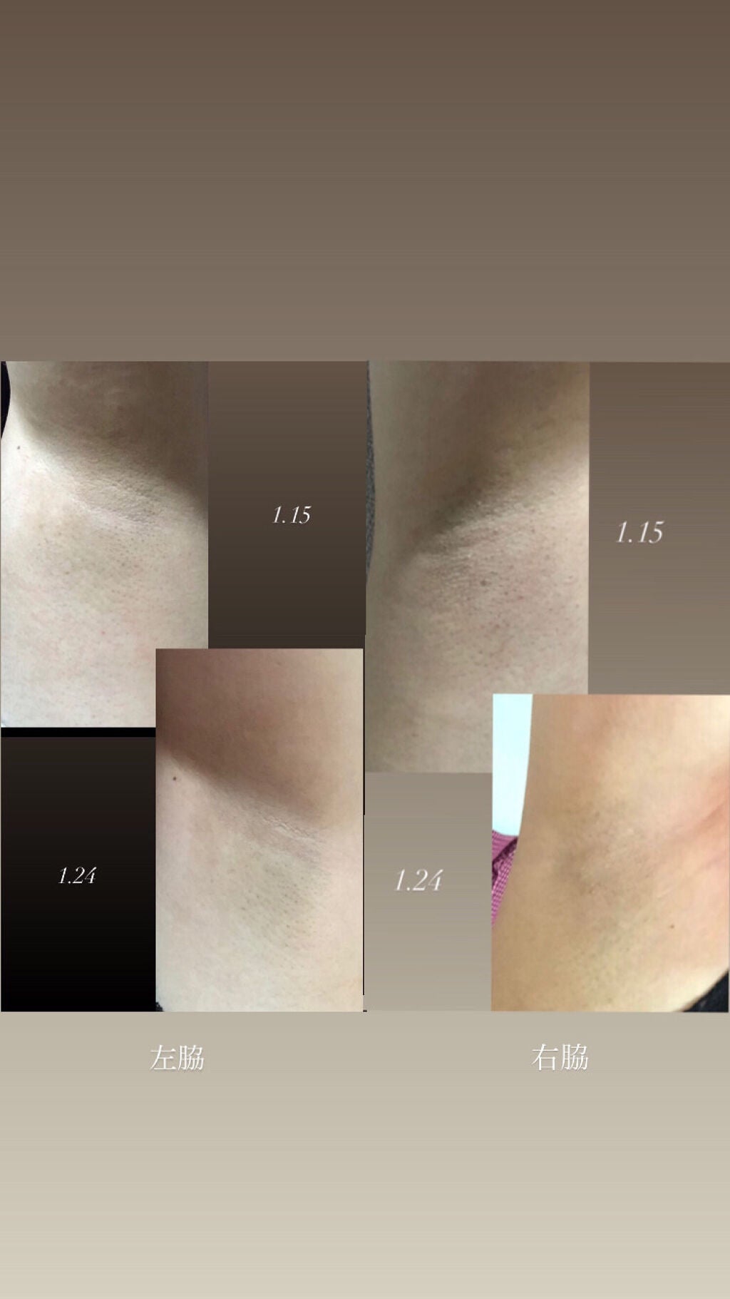 可愛くなりたい! on LIPS 「Qoo10の脱毛器,RICHSSES92枚目閲覧注意です!本当..」(2枚目)