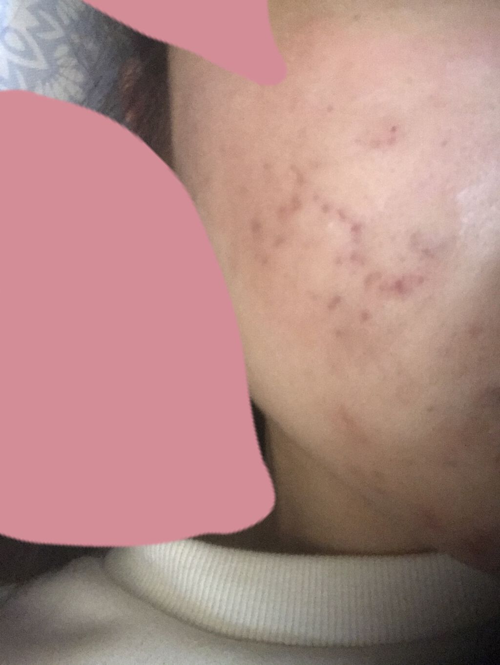 クリンダマイシンゲル(医薬品)/クラシエ薬品/その他を使ったクチコミ（2枚目）