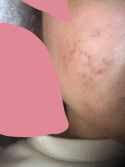 coral_make_3jl on LIPS 「前回、肌荒れが治ってきたという投稿をしましたが、今めちゃめちゃ..」(2枚目)