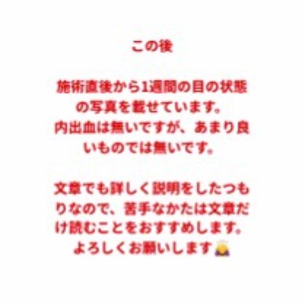 二重整形/その他を使ったクチコミ(2枚目)