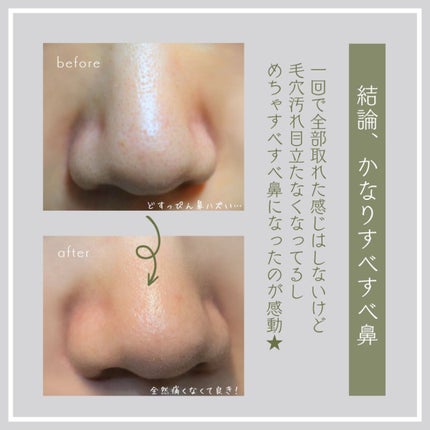 ブラックヘッドクリア2ステップノーズパッチ/DPU/シートマスク・パックを使ったクチコミ(5枚目)