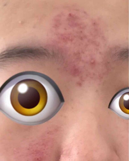 女の子になりたい on LIPS 「生理でさらに肌荒れがひどくなってしまいました、、、、2つもニキ..」(1枚目)