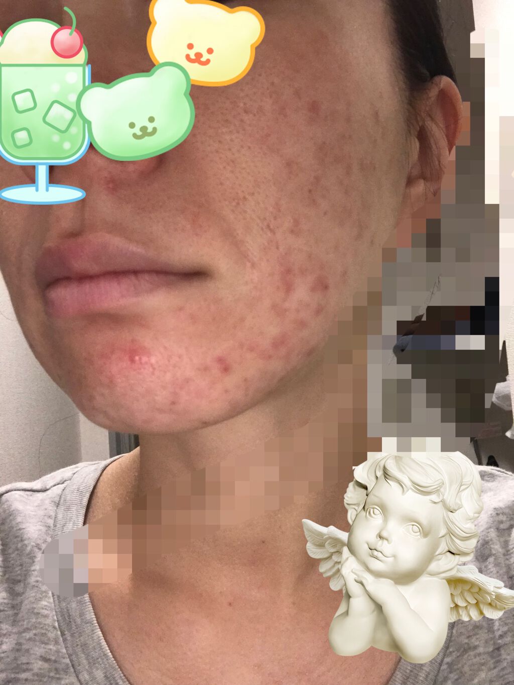 あーさん on LIPS 「自分用メモです✍️べピオゲルやり始めて1ヶ月以上たった途中経過..」(2枚目)