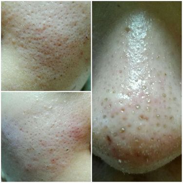 リファイニング クレイ パック ドクターベルツの効果に関する口コミ 角栓や毛穴の汚れ 皮脂がサッパリ取れます By 銀麦 混合肌 10代後半 Lips