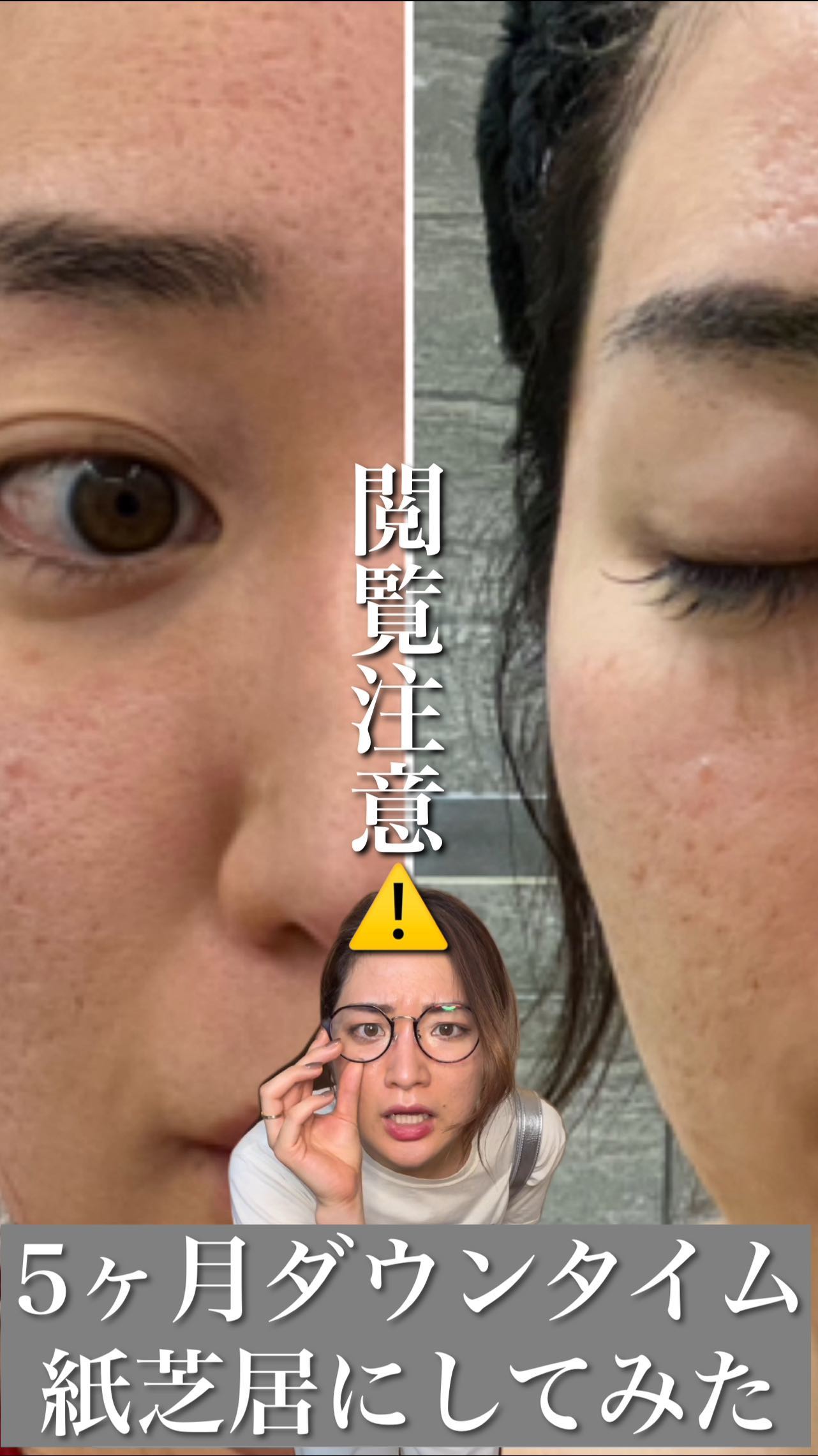 ⚠️PRでもなく、批判でもなく、体験談です⚠️

思春期ニキビから全顔ニキビでどうしようもない
クレーターを作って自尊心削がれまくった
クレーター歴15年の私も30歳になる…
というこのタイミングで、そろそろ、

「この肌なんとかならないか