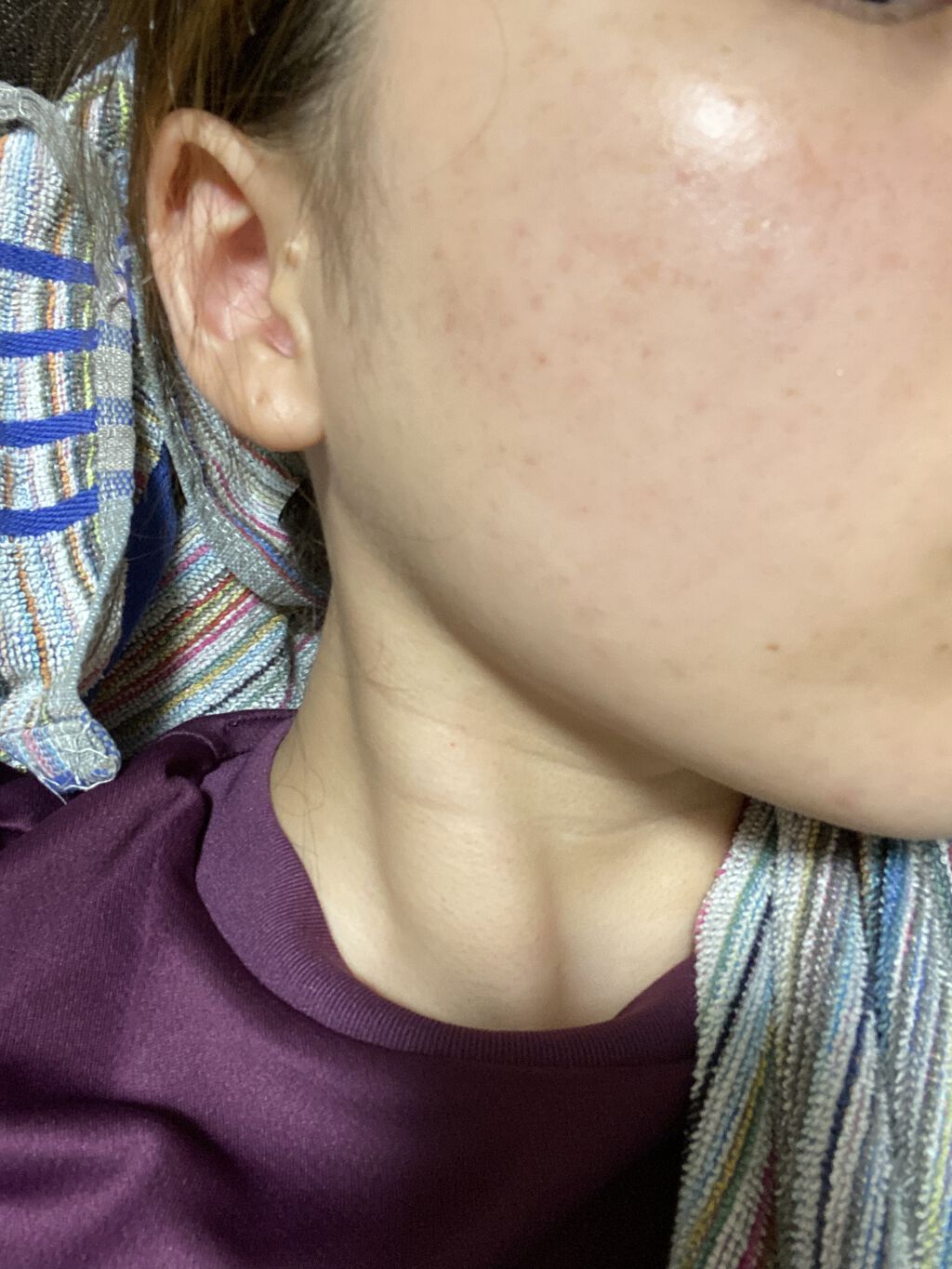 薬用アクネホワイトニング ジェル（部分用美容液）/DHC/美容液を使ったクチコミ（2枚目）