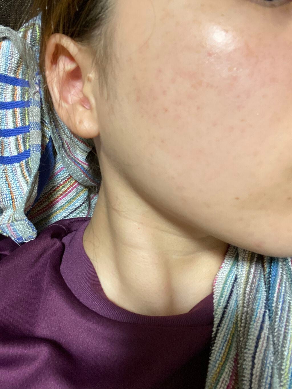 薬用アクネホワイトニング ジェル(部分用美容液)/DHC/美容液を使ったクチコミ(2枚目)