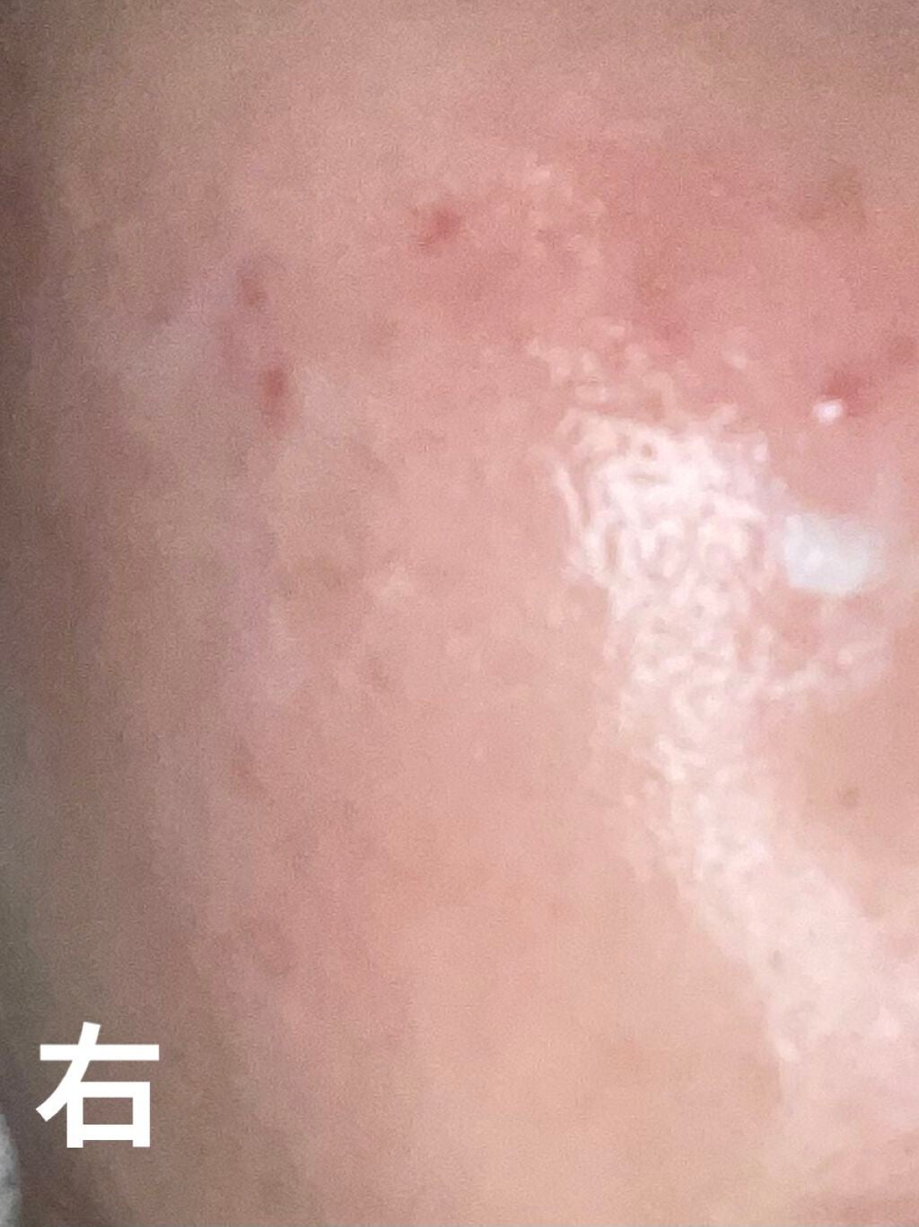 十味敗毒湯 ジュウミハイドクトウ(医薬品)/クラシエ薬品/その他を使ったクチコミ(2枚目)