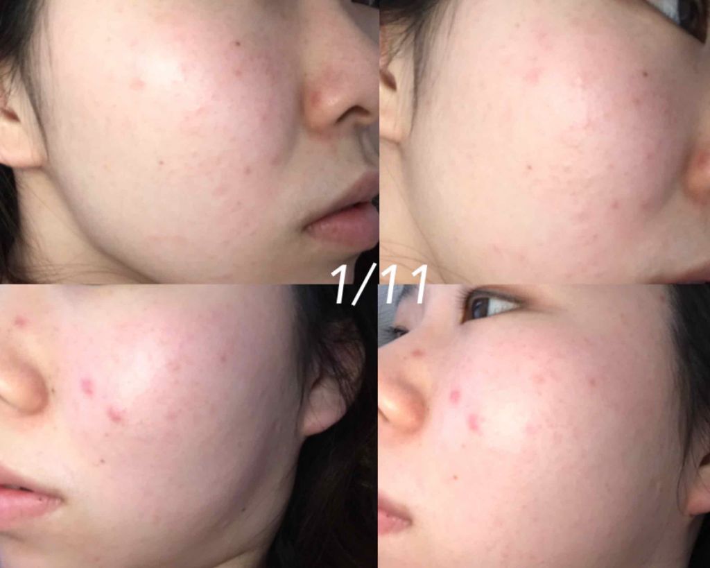 薬用 しみ 集中対策 美容液/メラノCC/美容液を使ったクチコミ(3枚目)