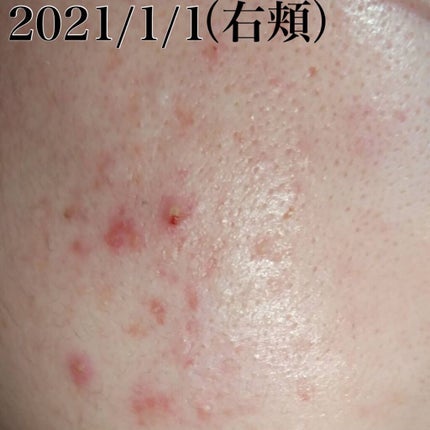 楓@LIPSパートナー on LIPS 「#ニキビスキンケア初投稿です。いきなり黒歴史を公開いたします笑..」(2枚目)