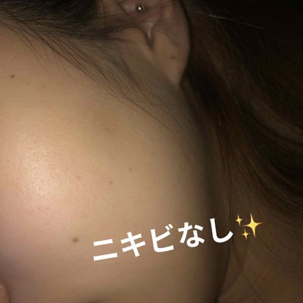ニキビ治療薬(医薬品)/メンソレータム アクネス/その他を使ったクチコミ(1枚目)