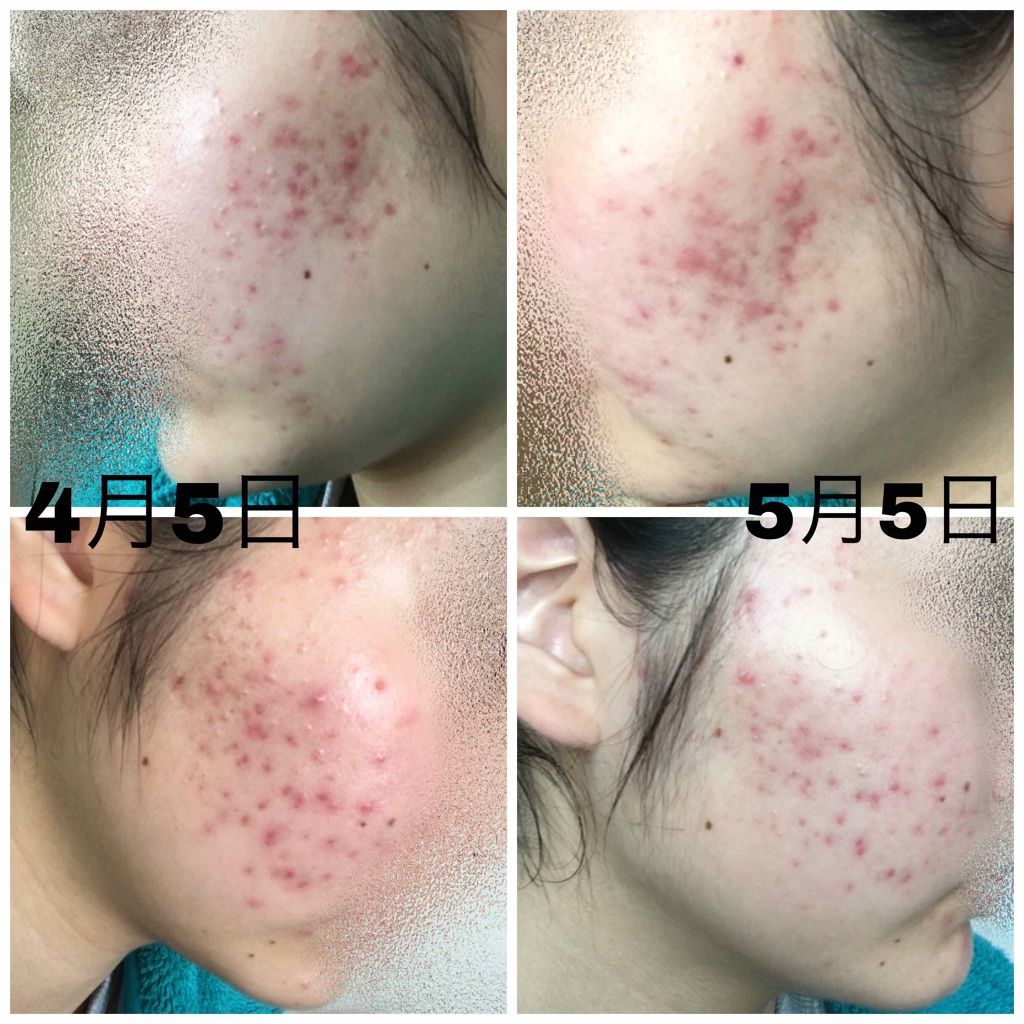 薬用保湿化粧水/オードムーゲ/化粧水を使ったクチコミ(4枚目)