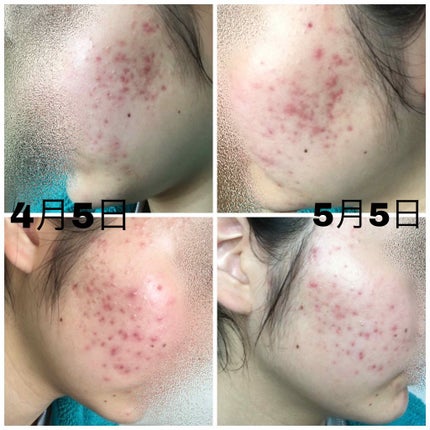 薬用保湿化粧水/オードムーゲ/化粧水を使ったクチコミ(4枚目)