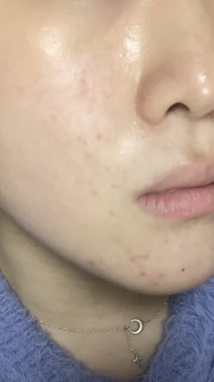 リードルショット100/VT/美容液を使ったクチコミ（3枚目）