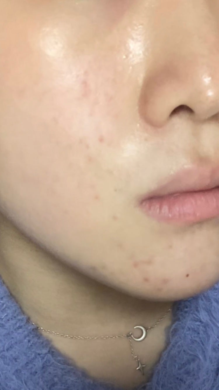 リードルショット100/VT/美容液を使ったクチコミ(3枚目)